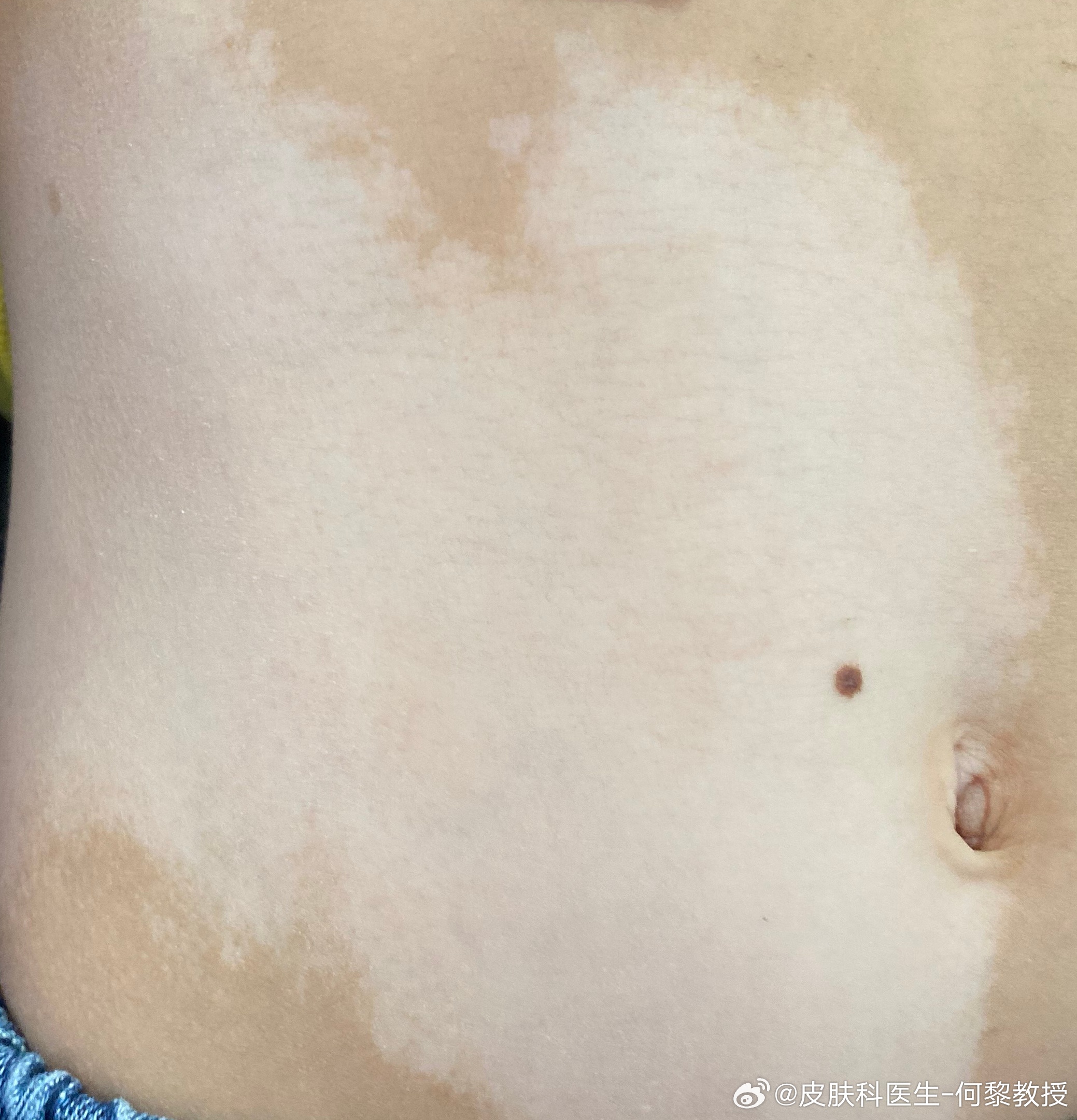 白斑治療新進(jìn)展揭秘，小巷深處的秘密小店探索之路