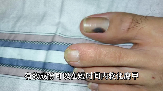 揭秘醫(yī)院治療灰指甲價格與小巷深處的特色小店探秘