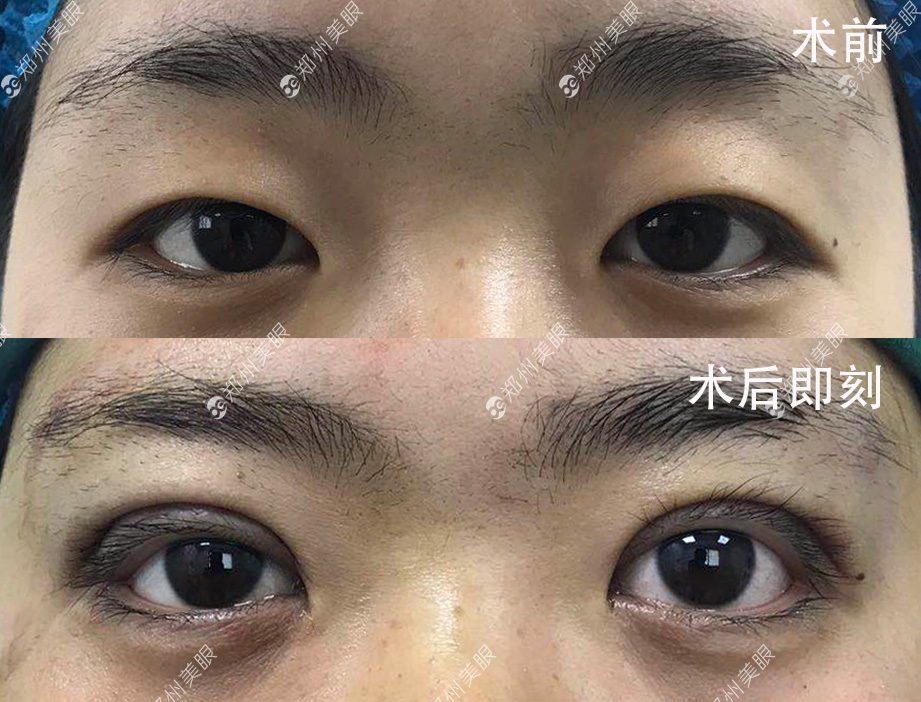 最新雙眼皮手術(shù)技巧，創(chuàng)新割雙眼皮方法解析